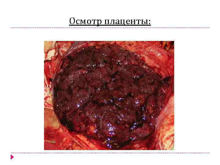 Осмотр плаценты: 