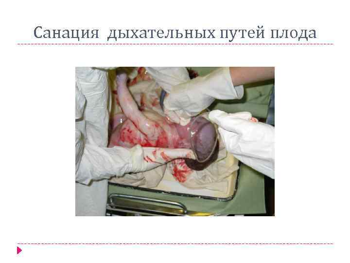 Санация дыхательных путей плода 
