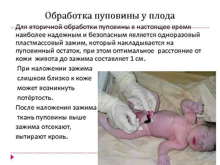 Обработка пуповины у плода Для вторичной обработки пуповины в настоящее время наиболее надежным и