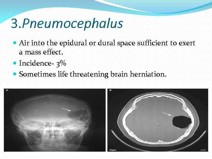 3. Pneumocephalus Air into the epidural or dural space sufficient to exert a mass