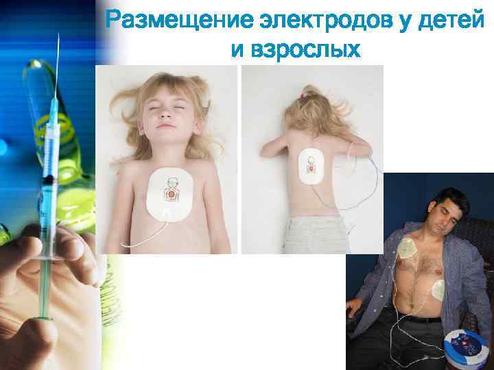 Размещение электродов у детей и взрослых 