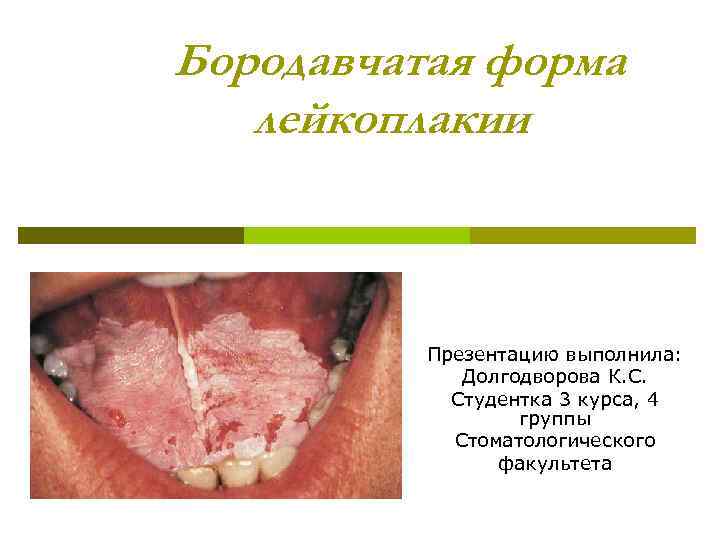 Бородавчатая форма лейкоплакии Презентацию выполнила: Долгодворова К. С. Студентка 3 курса, 4 группы Стоматологического