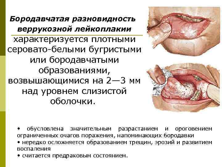 Бородавчатая разновидность веррукозной лейкоплакии характеризуется плотными серовато-белыми бугристыми или бородавчатыми образованиями, возвышающимися на 2—