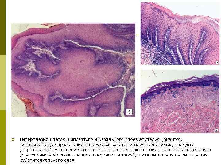 p Гиперплазия клеток шиповатого и базального слоев эпителия (акантоз, гиперкератоз), образование в наружном слое