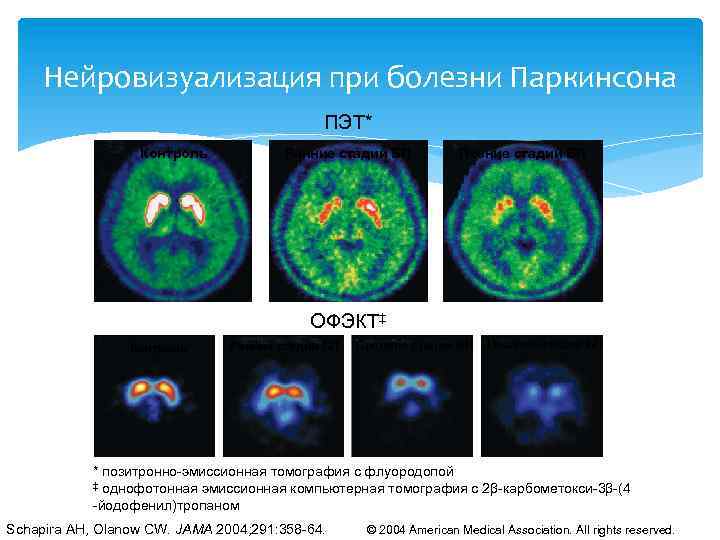 Нейровизуализация при болезни Паркинсона ПЭТ* Контроль Ранние стадии БП Early-Stage PD Позние стадии БП
