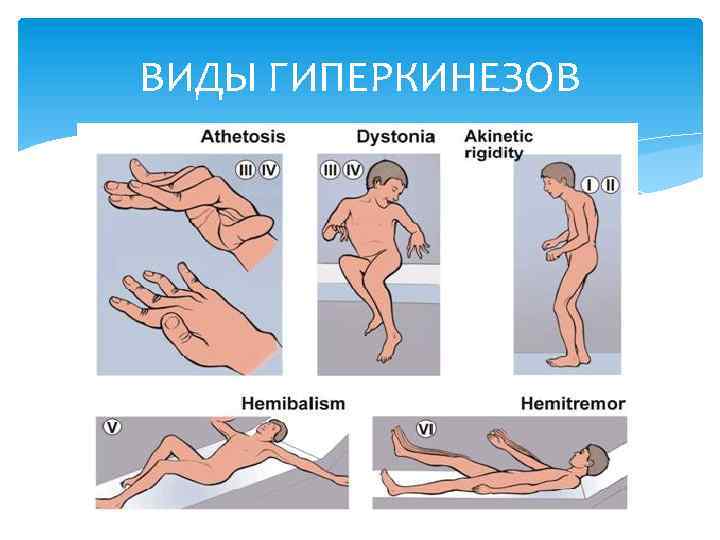 ВИДЫ ГИПЕРКИНЕЗОВ 