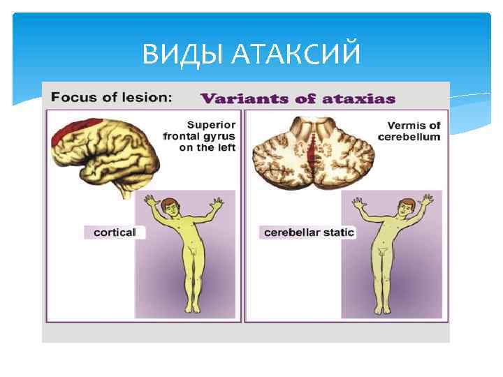 Признаки атаксии