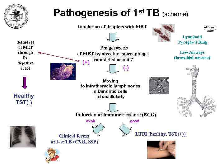 Pathogenesis of 1 st TB (scheme) Inhalation of droplets with MBT Removal of MBT