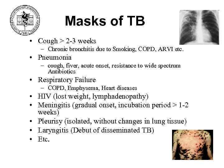 Masks of TB • Cough > 2 -3 weeks – Chronic bronchitis due to