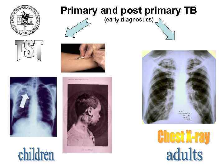 Primary and post primary TB (early diagnostics) 