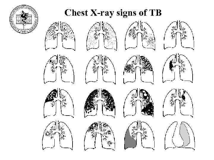 Chest X-ray signs of TB 