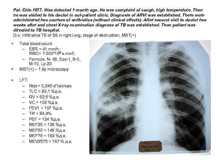 Pat. Chis. 1977. Was detected 1 month ago. He was complaint of cough, high