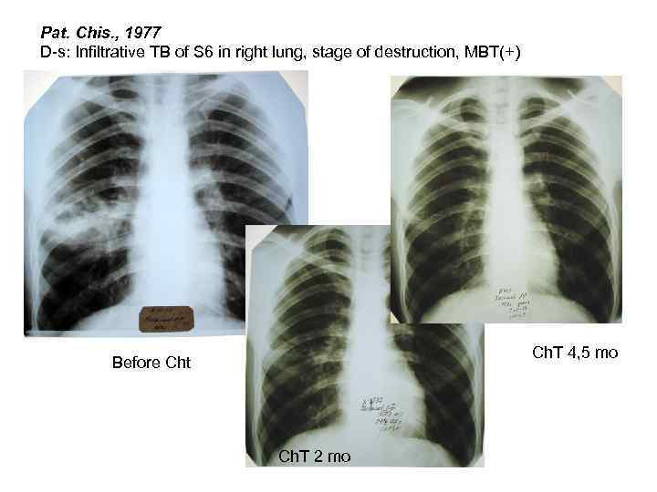 Pat. Chis. , 1977 D-s: Infiltrative TB of S 6 in right lung, stage