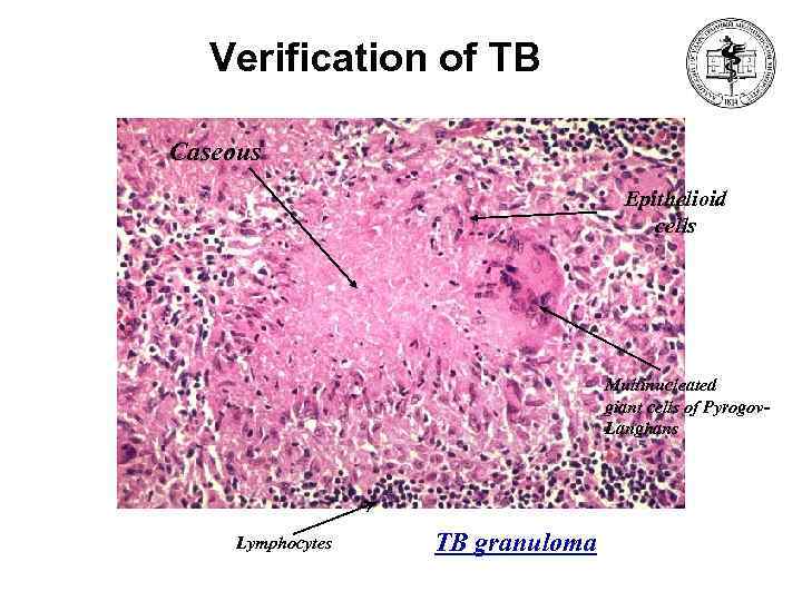 Verification of TB Caseous Epithelioid cells Multinucleated giant cells of Pyrogov. Langhans Lymphocytes TB