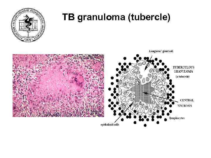 TB granuloma (tubercle) 