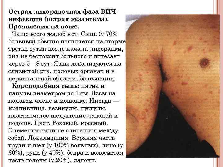 Острая лихорадочная фаза ВИЧинфекции (острая экзантема). Проявления на коже. Чаще всего жалоб нет. Сыпь