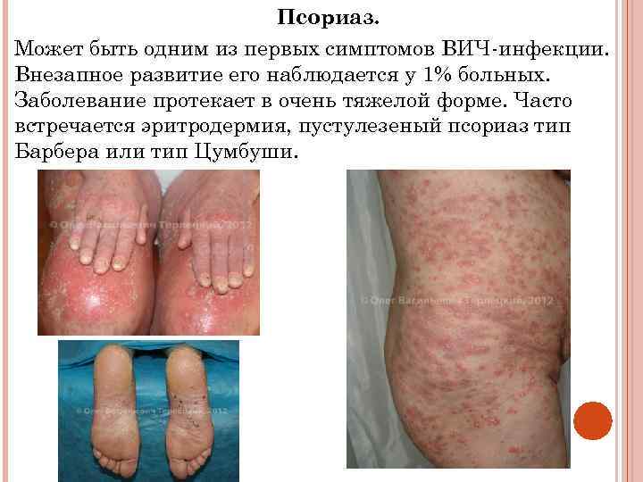 Псориаз. Может быть одним из первых симптомов ВИЧ-инфекции. Внезапное развитие его наблюдается у 1%