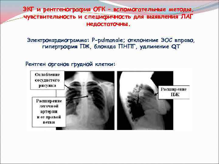 ЭКГ и рентгенография ОГК – вспомогательные методы, чувствительность и специфичность для выявления ЛАГ недостаточны.