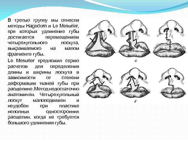 В третью группу мы отнесли методы Hagedorn и Le Меsurier, при которых удлинение губы