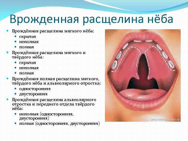 Врожденная расщелина нёба Врождённая расщелина мягкого нёба: скрытая неполная Врождённая расщелина мягкого и твёрдого