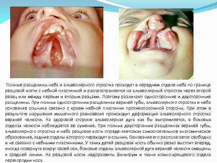  Полные расщелины неба и альвеолярного отростка проходят в переднем отделе неба по границе