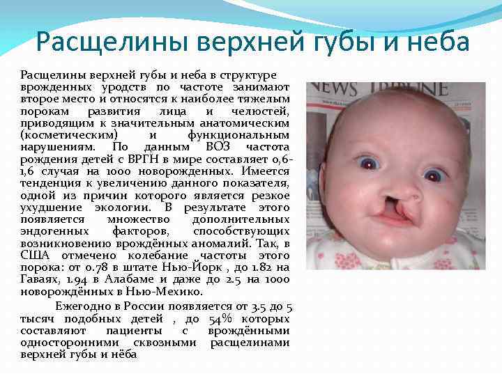 Расщелины верхней губы и неба в структуре врожденных уродств по частоте занимают второе место