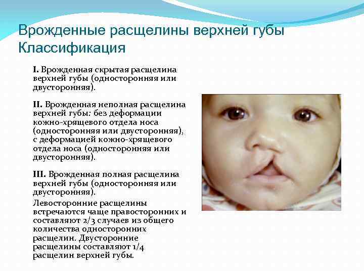 Врожденные расщелины верхней губы Классификация I. Врожденная скрытая расщелина верхней губы (односторонняя или двусторонняя).