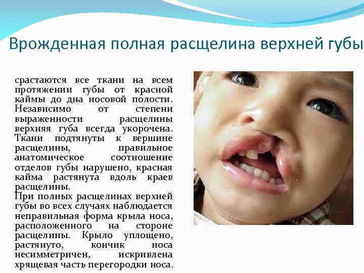 Врожденная полная расщелина верхней губы срастаются все ткани на всем протяжении губы от красной