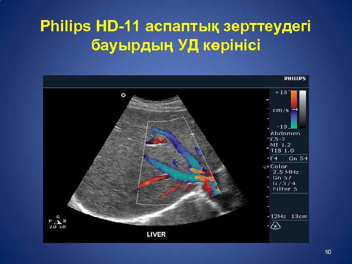  Philips HD-11 аспаптық зерттеудегі бауырдың УД көрінісі 60 