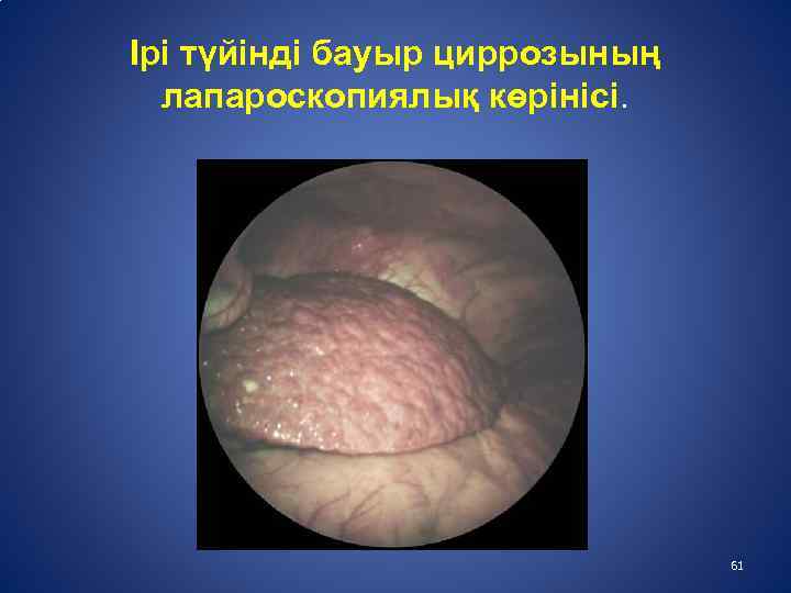 Ірі түйінді бауыр циррозының лапароскопиялық көрінісі. 61 