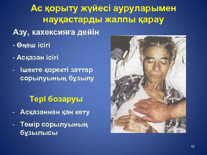 Ас қорыту жүйесі ауруларымен науқастарды жалпы қарау Азу, кахексияға дейін - Өңеш ісігі -