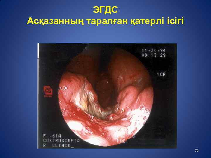  ЭГДС Асқазанның таралған қатерлі ісігі 79 