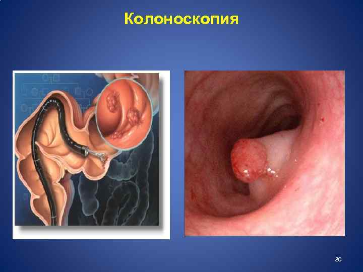 Колоноскопия 80 