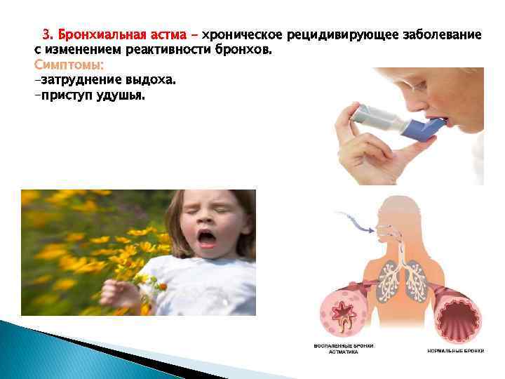 3. Бронхиальная астма - хроническое рецидивирующее заболевание с изменением реактивности бронхов. Симптомы: -затруднение выдоха.