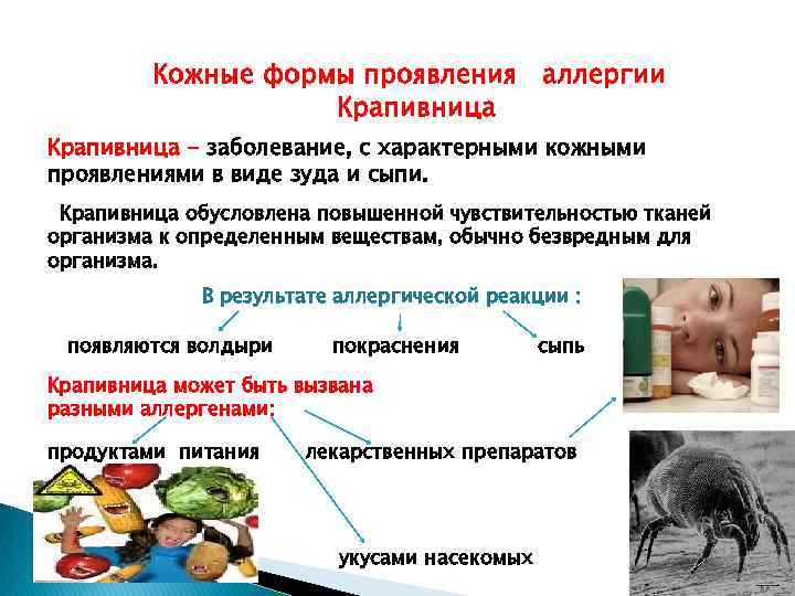 Кожные формы проявления аллергии Крапивница - заболевание, с характерными кожными проявлениями в виде зуда