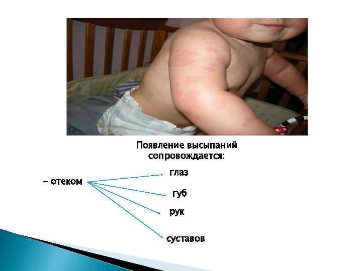 Появление высыпаний сопровождается: - отеком глаз губ рук суставов 