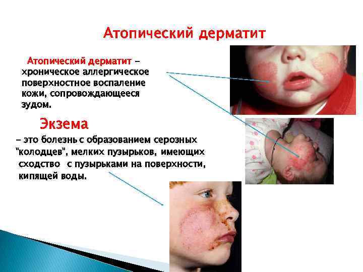 Атопический дерматит хроническое аллергическое поверхностное воспаление кожи, сопровождающееся зудом. Экзема - это болезнь с