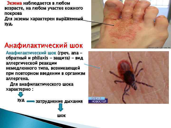 Экзема наблюдается в любом возрасте, на любом участке кожного покрова Для экземы характерен выраженный