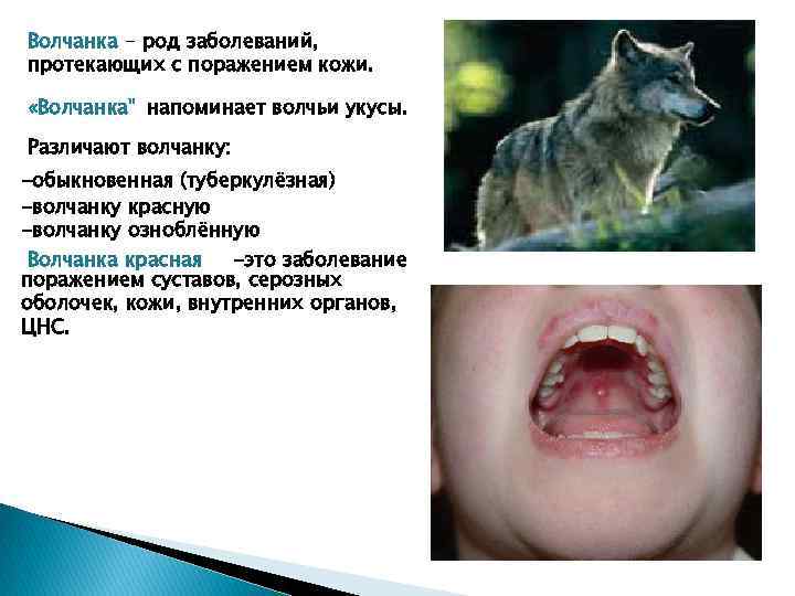 Волчанка - род заболеваний, протекающих с поражением кожи. «Волчанка