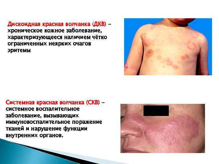 Дискоидная красная волчанка (ДКВ) хроническое кожное заболевание, характеризующееся наличием чётко ограниченных неярких очагов эритемы