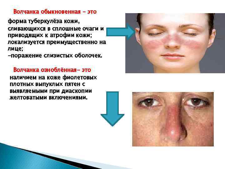 Волчанка обыкновенная - это форма туберкулёза кожи, сливающихся в сплошные очаги и приводящих к