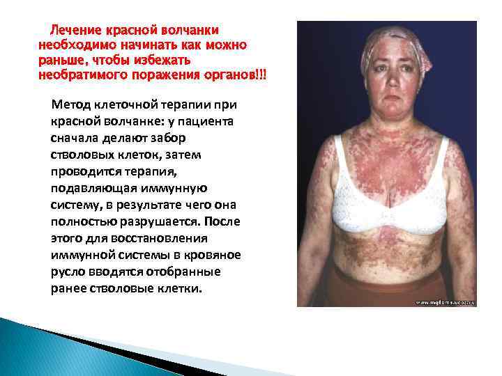 Лечение красной волчанки необходимо начинать как можно раньше, чтобы избежать необратимого поражения органов!!! Метод