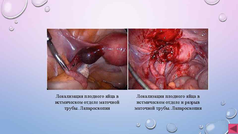 Локализация плодного яйца в истмическом отделе маточной трубы. Лапароскопия Локализация плодного яйца в истмическом