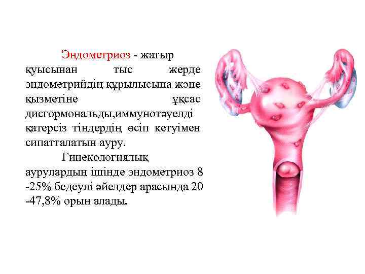 Эндометриоз - жатыр қуысынан тыс жерде эндометрийдің құрылысына және қызметіне ұқсас дисгормональды, иммунотәуелді қатерсіз