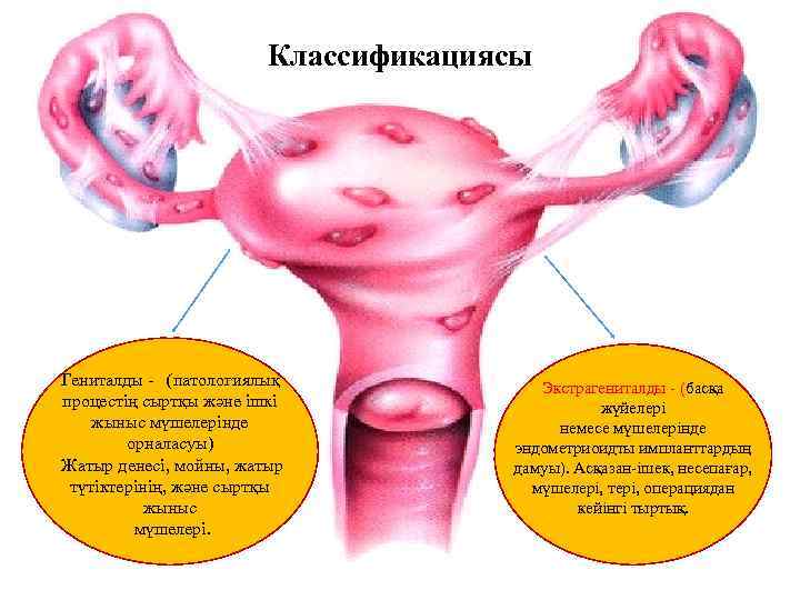 Классификациясы Гениталды - (патологиялық процестің сыртқы және ішкі жыныс мүшелерінде орналасуы) Жатыр денесі, мойны,