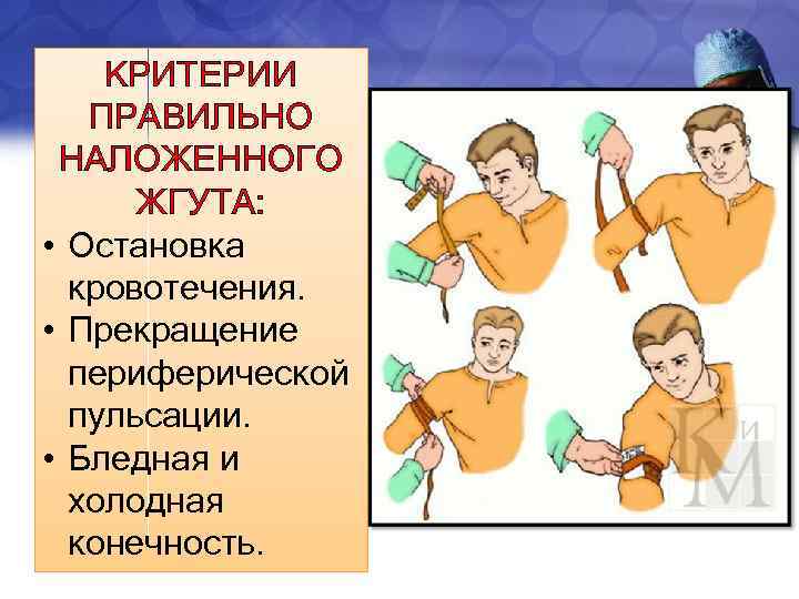 КРИТЕРИИ ПРАВИЛЬНО НАЛОЖЕННОГО ЖГУТА: • Остановка кровотечения. • Прекращение периферической пульсации. • Бледная и