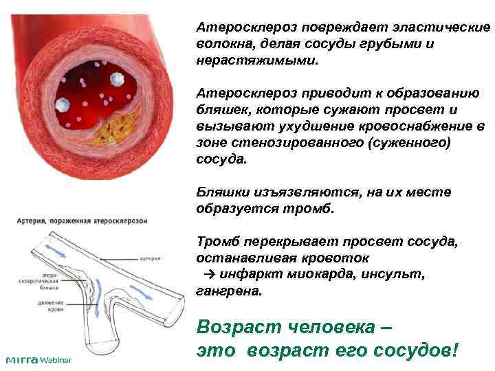 Атеросклероз повреждает эластические волокна, делая сосуды грубыми и нерастяжимыми. Атеросклероз приводит к образованию бляшек,