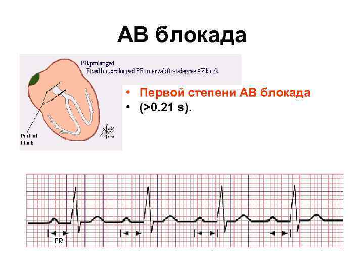 Блокады сердца презентация