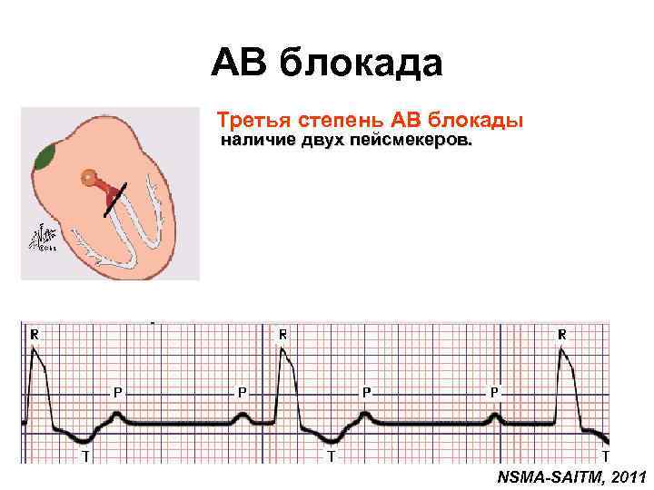 AВ блокада Третья степень АВ блокады наличие двух пейсмекеров. NSMA-SAITM, 2011 