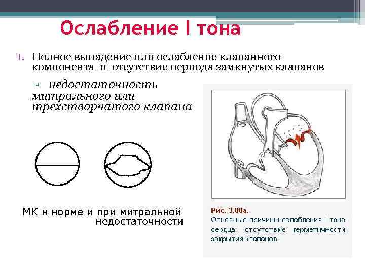 Недостаточность трехстворчатого клапана рисунок